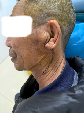 乱石堆中寻“金线”！潜江市中心医院耳鼻咽喉科成功切除一例巨大腮腺肿瘤（已修改）.docx