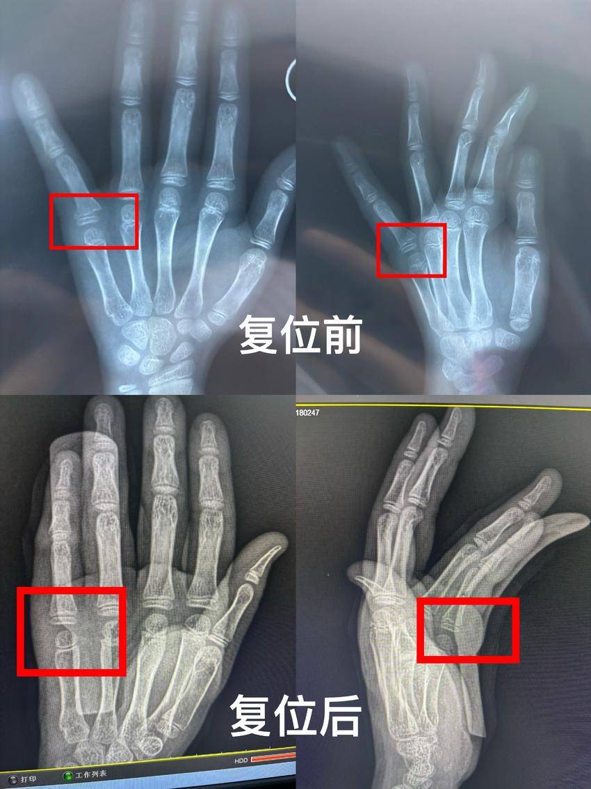 8岁娃摔伤致小指骨折，江夏中医“何氏正骨”秒速复位免除手术痛苦 - 副本.docx