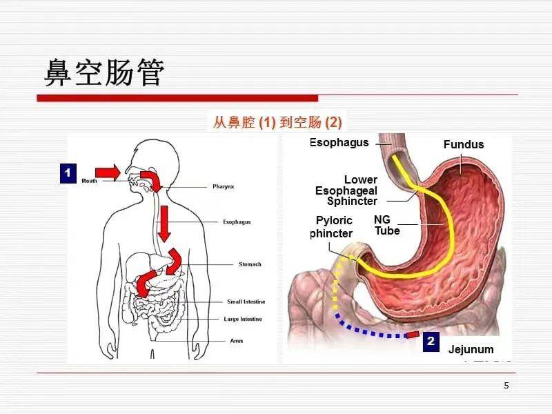 鼻肠管置入方法线路图图片