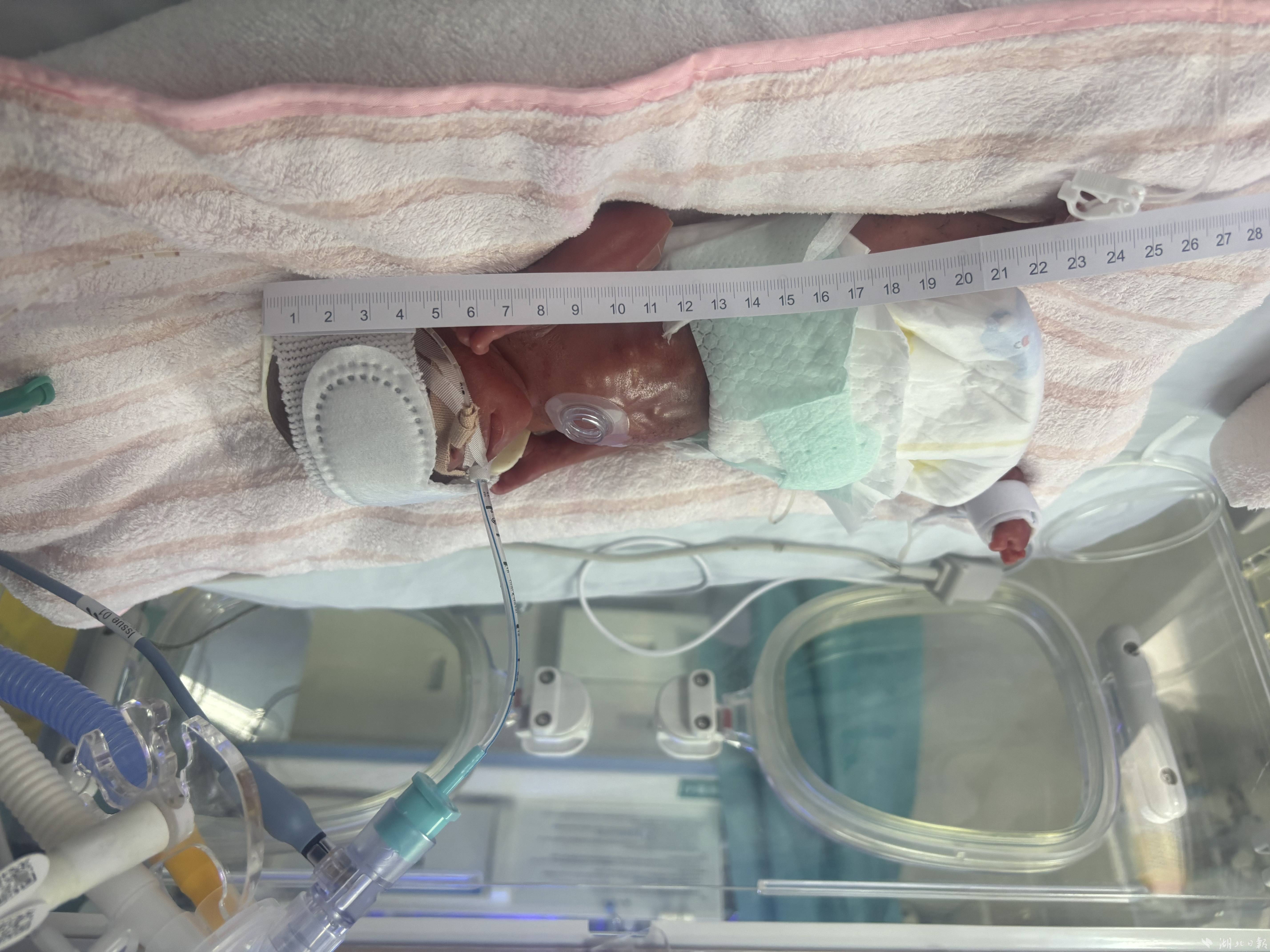 刚出生时，超超身高不足24厘米。