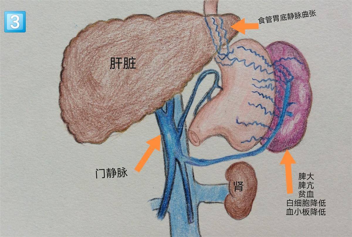 这些手绘漫画记录了一位巨脾患者成功实施腹腔镜手术的全过程