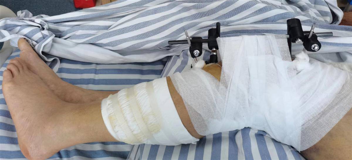 点赞手术3小时大悟中医院成功保住患者左腿