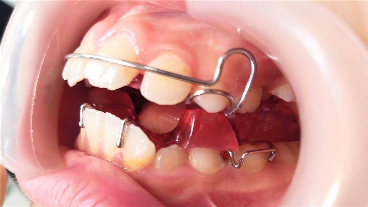 小龅牙必须拔牙矫正吗