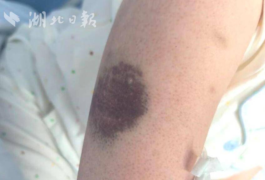 患者小婷(化名)身上出现的乌青